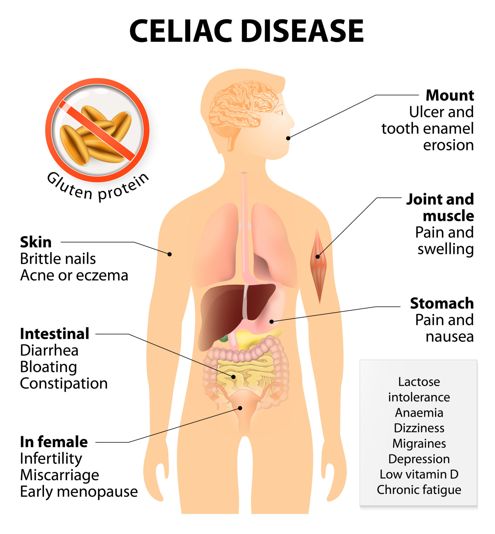 What Is Coeliac Disease And How Does It Affect The Body